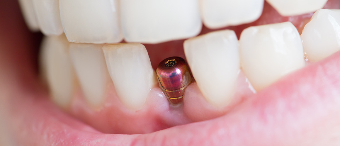 Dental Implant Restoration Haywards Heath